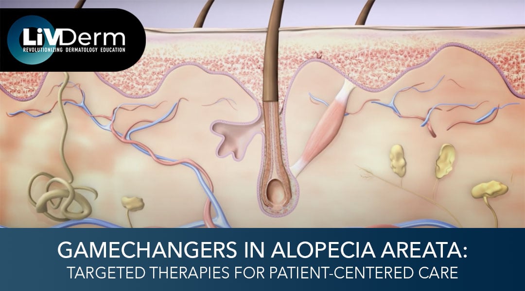 Gamechangers in Alopecia Areata: Targeted Therapies for Patient-Centered Care