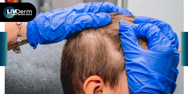 EMA validates marketing authorization for pediatric alopecia areata treatment