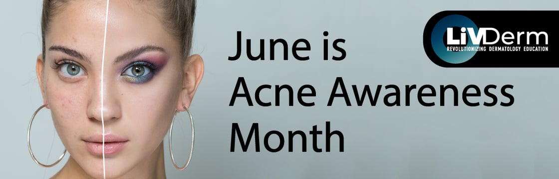 June-is-Acne-Awareness-Month-Newsletter