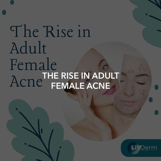 The Rise in Adult Female Acne