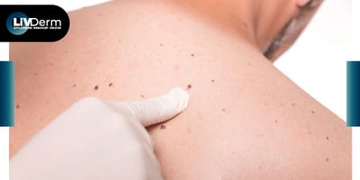 Microsatellites may be associated with poorer survival outcomes in melanoma