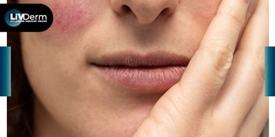 National Rosacea Society marks 30 years of raising awareness, supporting research