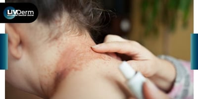 Investigational Topical Peptide May Help Tame Eczema