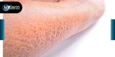 An Overview of Harlequin Ichthyosis