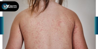 Importance of Understanding Data of Generalized Pustular Psoriasis Data