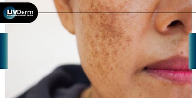 Wound Care Following MMS Critical in Preventing Hyperpigmentation in Skin of Color