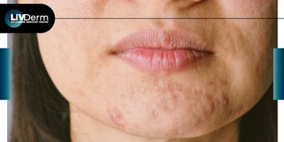 New Research Reveals Roughly 4 in 5 Acne Sufferers Have Missed Moments in their Life Due to Acne