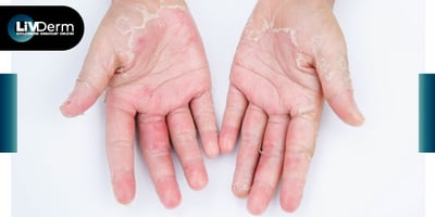 “Natural” Skincare Products May Contain Allergens Causing Contact Dermatitis