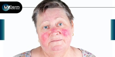 Key Insights into Rhinophyma in Rosacea