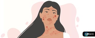 Making an Impact on Acne