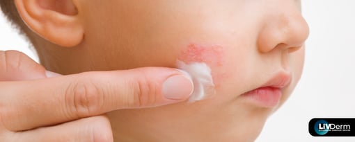 Ruxolitinib Cream for Pediatric Atopic Dermatitis